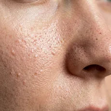 Diffuse Rötung und Irritation